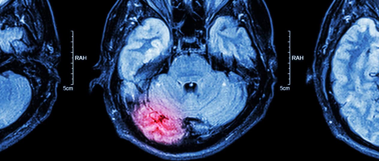 Parkville brain injury lawyers