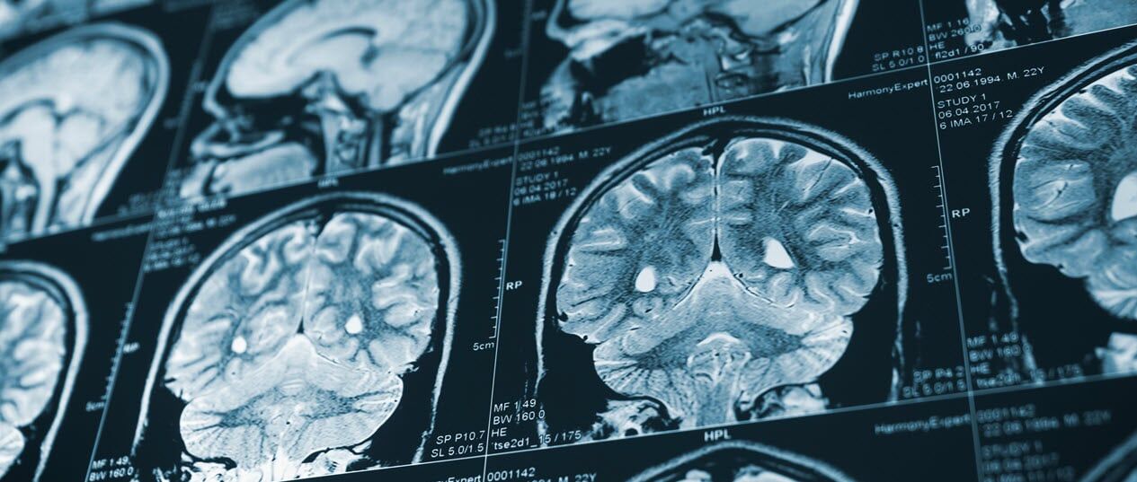 Olathe brain injury lawyers