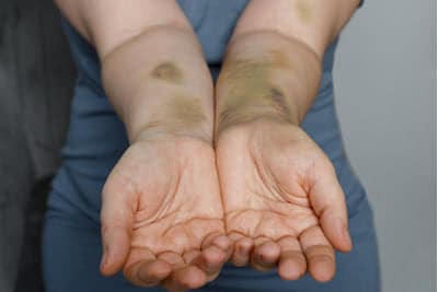 bone bruises from car accidents